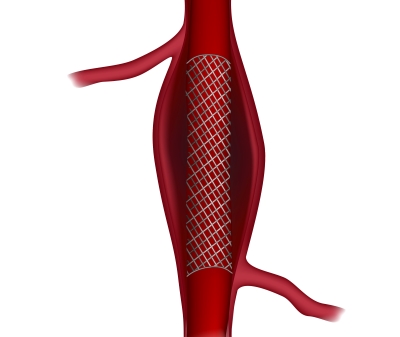 Endovasculaire behandeling