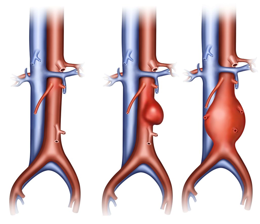 Aneurysma voorbeeld